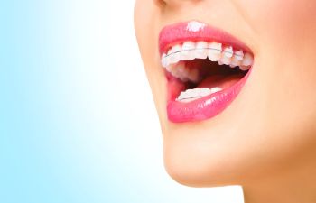Close-up of a smiling person with pink lipstick and clear braces on their teeth against a blue background.