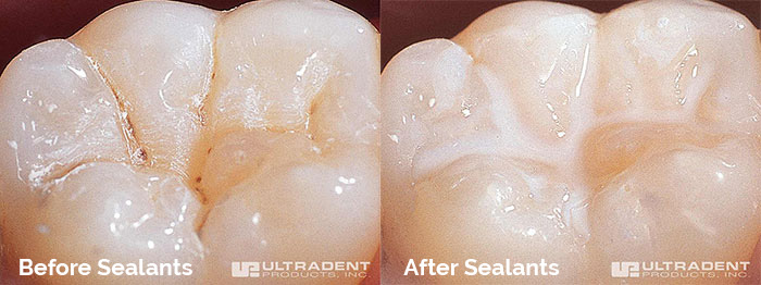 Dental Sealants