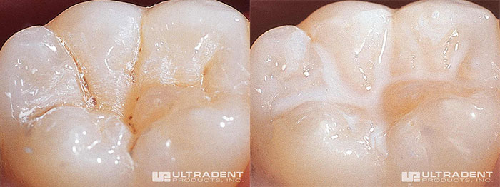 Close-up comparison of two molars: left shows a tooth with dark grooves, right shows the same tooth with lighter grooves, indicating a dental treatment or sealant application.